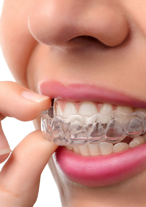 Invisalign